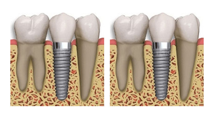 زراعة الأسنان البديل الأفضل للأسنان المفقودة