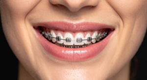 a picture showcasing an example for metal dental braces